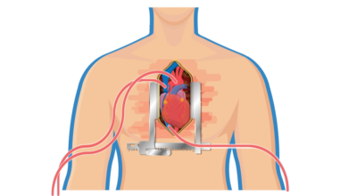 عملية القلب المفتوح التحضيرات وكيف تتم العملية 7308 390x220 - جراحة القلب المفتوح