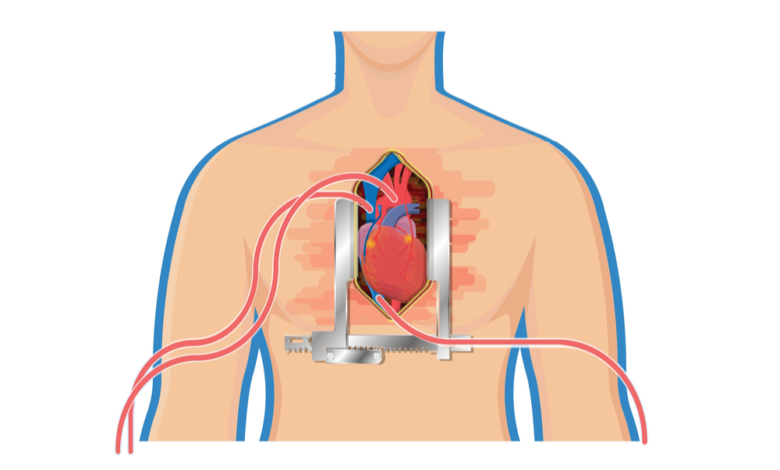 عملية القلب المفتوح التحضيرات وكيف تتم العملية 7308 780x470 - جراحة القلب المفتوح